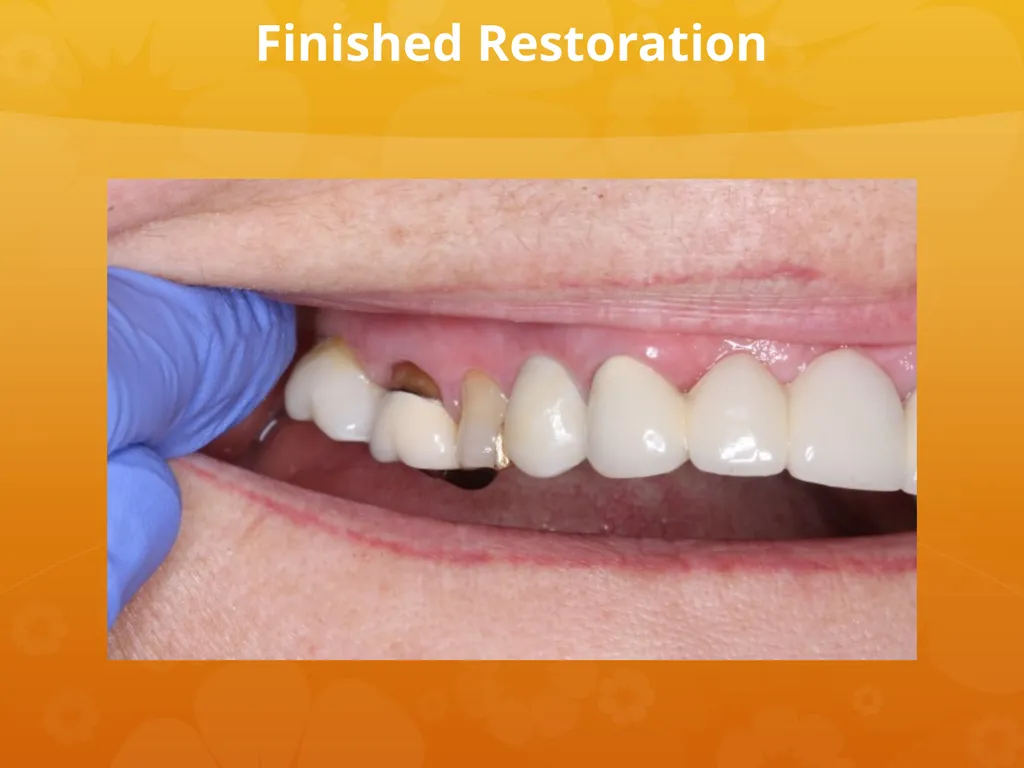 OCO Biomedical Custom Abutment and Crown With - slide 25 of 26