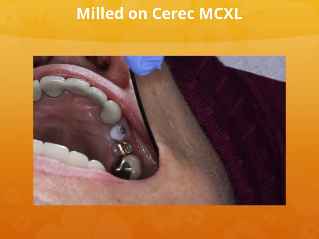OCO Biomedical Custom Abutment and Crown With - slide 23 of 26