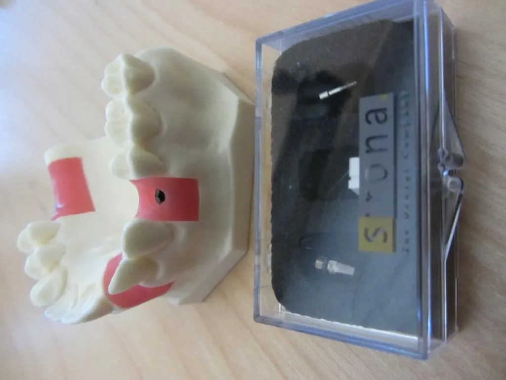 OCO Biomedical Custom Abutment and Crown With - slide 4 of 26
