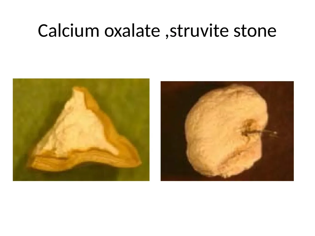 NEPHROLITHIASIS AYURVEDIC AND MODERN CONCEPT BY DR - slide 25 of 29