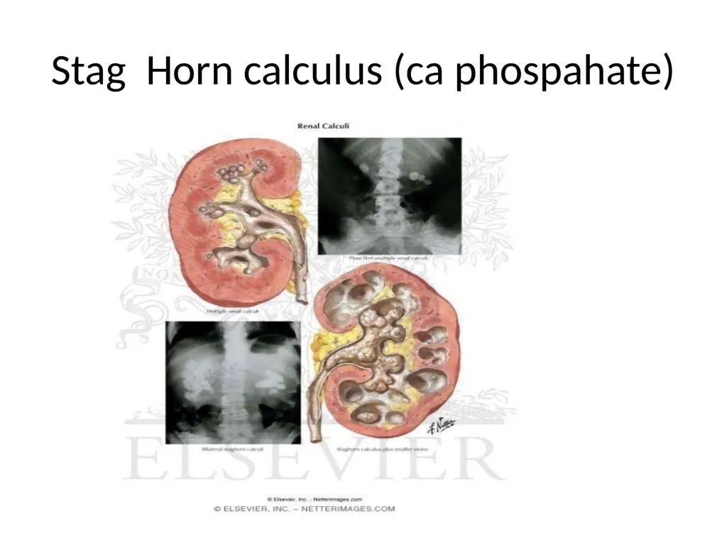NEPHROLITHIASIS AYURVEDIC AND MODERN CONCEPT BY DR - slide 28 of 29