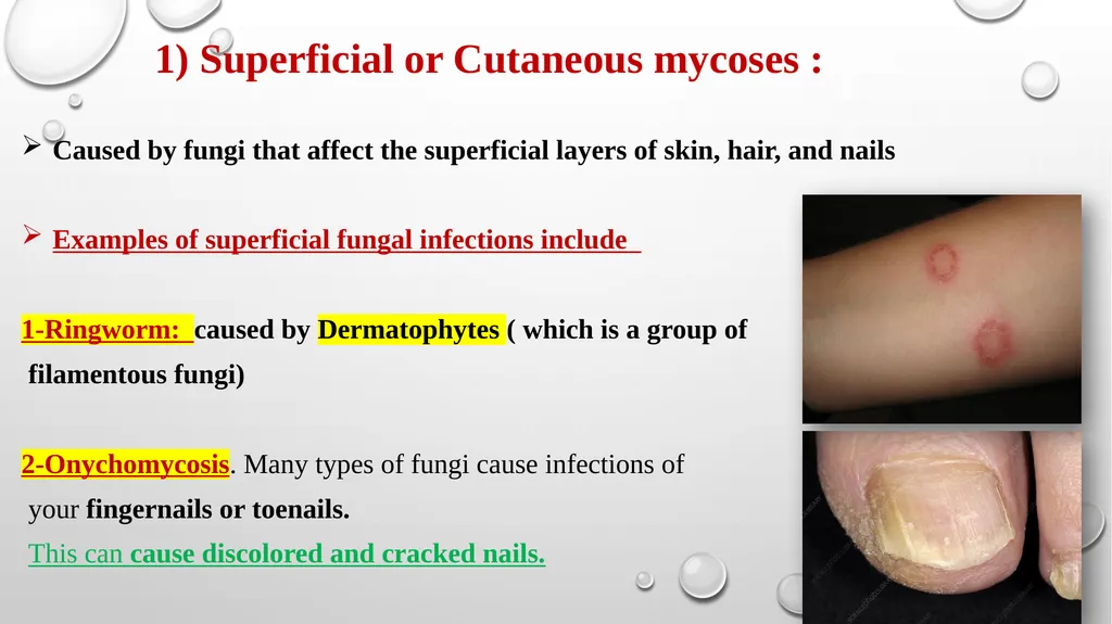 Medical Mycology Lab2 Mycosis What is Mycosis ? - slide 4 of 19