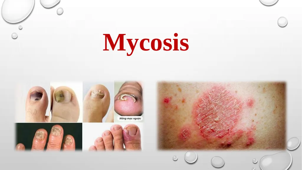 Medical Mycology Lab2 Mycosis What is Mycosis ? - slide 2 of 19