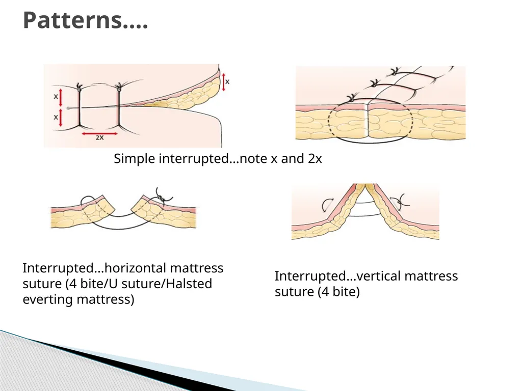 SUTURE – MATERIALS & METHODS Dr. Rudra Pratap - slide 41 of 45