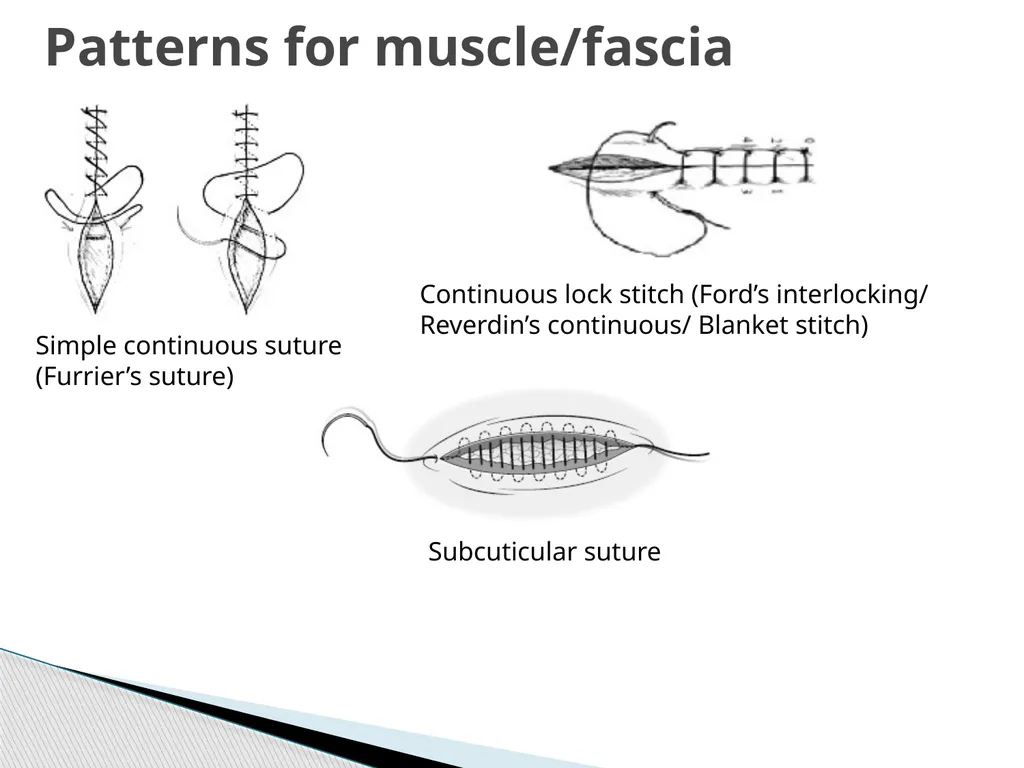 SUTURE – MATERIALS & METHODS Dr. Rudra Pratap - slide 43 of 45