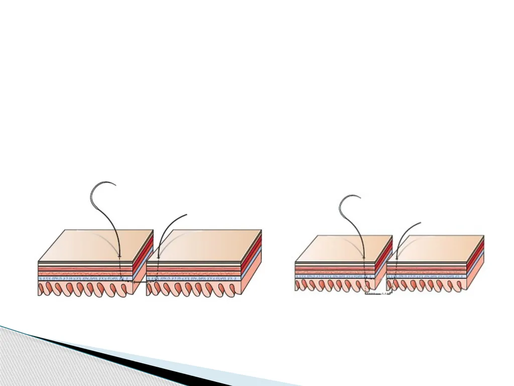 SUTURE – MATERIALS & METHODS Dr. Rudra Pratap - slide 44 of 45