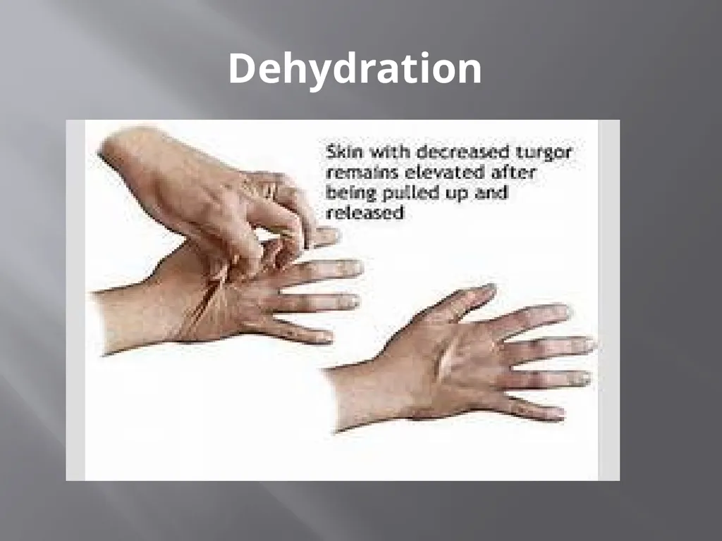 Water and Electrolyte Balance Mrs. L. - slide 28 of 32