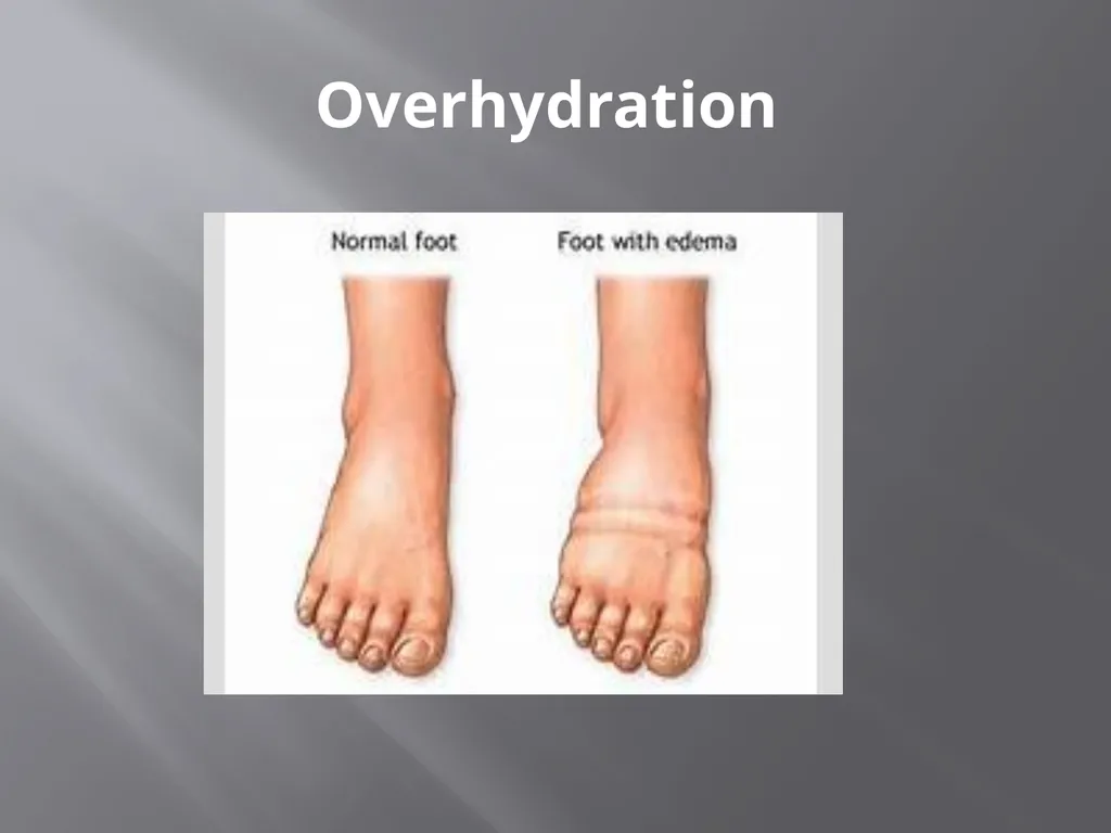 Water and Electrolyte Balance Mrs. L. - slide 25 of 32
