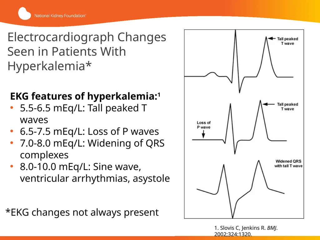 Evaluation and Management of Hyperkalemia This - slide 20 of 35