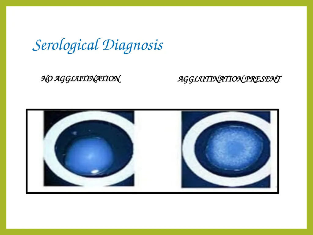 Cryptococcal meningitis Dr. Priyanka Chaturvedi - slide 29 of 30