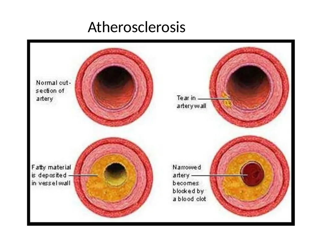 Hyper Lipidemia and Hypertension - slide 4 of 24