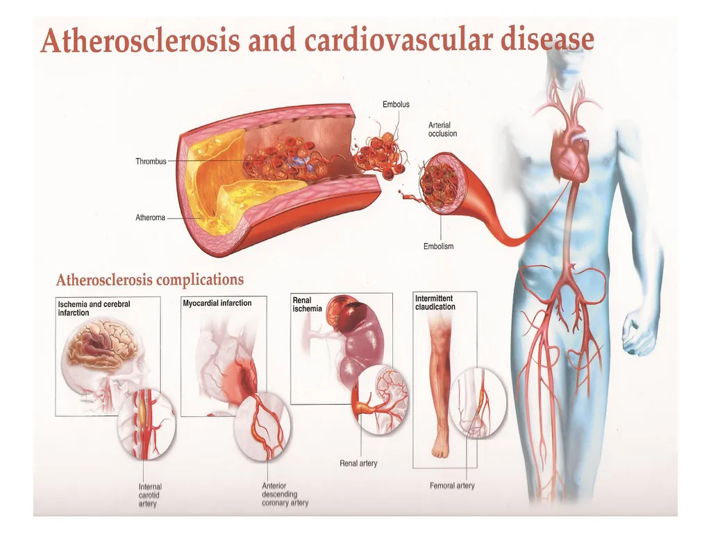 Hyper Lipidemia and Hypertension - slide 9 of 24