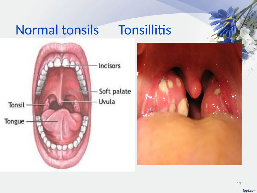 Upper Respiratory System Disorder Lecturer - slide 17 of 26