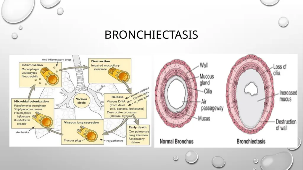 Obstructive and restrictive Lung Disease Jed - slide 28 of 36