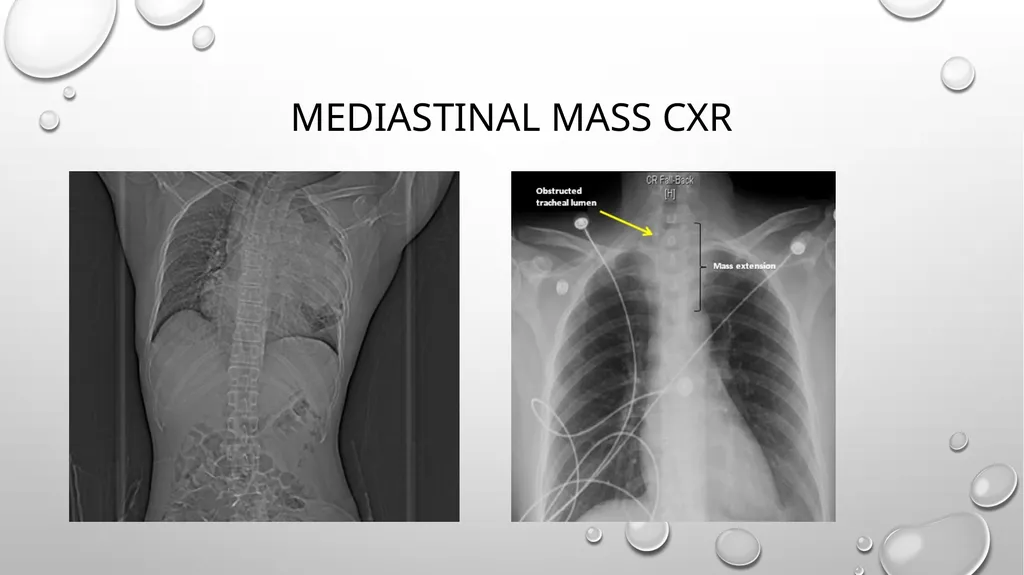 Obstructive and restrictive Lung Disease Jed - slide 33 of 36