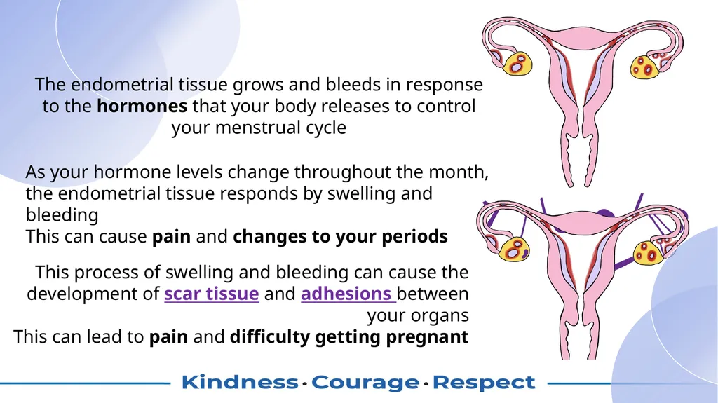 Symptoms in endometriosis and what causes them? - slide 4 of 6