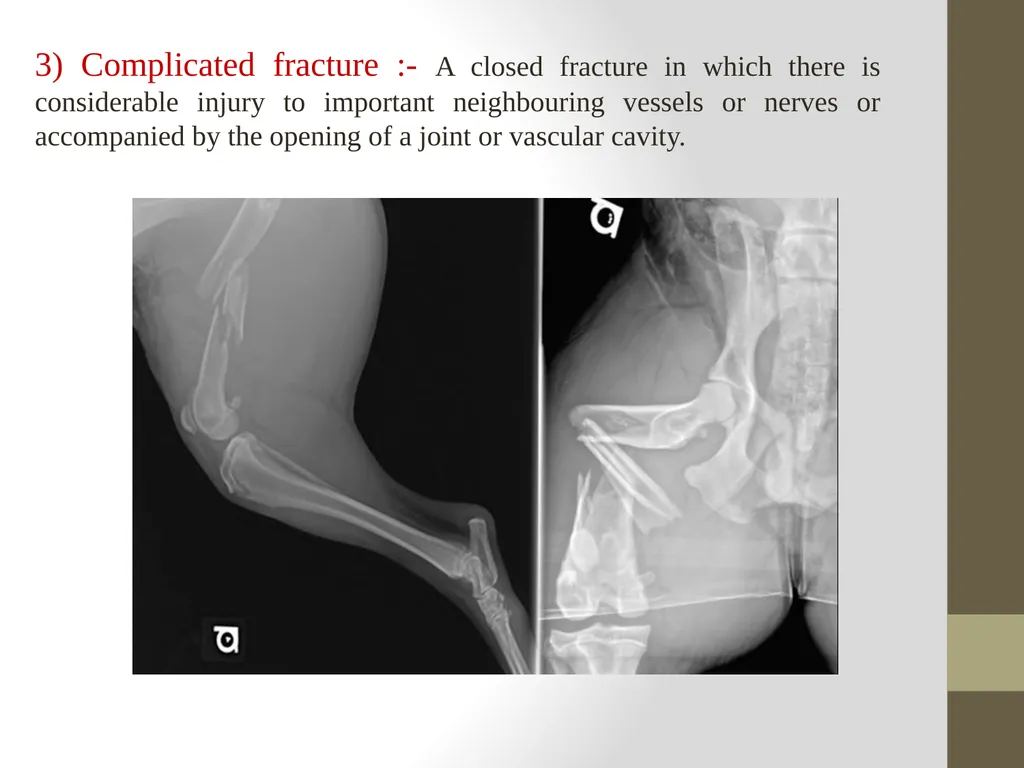 FRACTURE CLASSIFICATION Submitted by:- DR.Kumari - slide 4 of 16