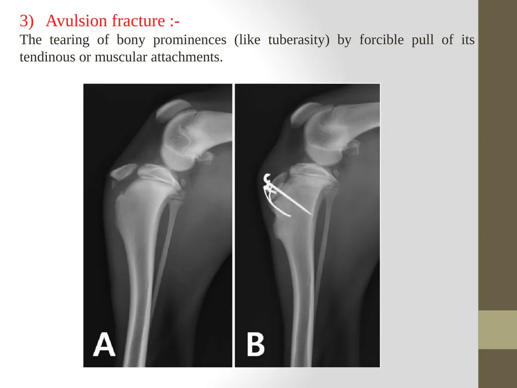FRACTURE CLASSIFICATION Submitted by:- DR.Kumari - slide 7 of 16