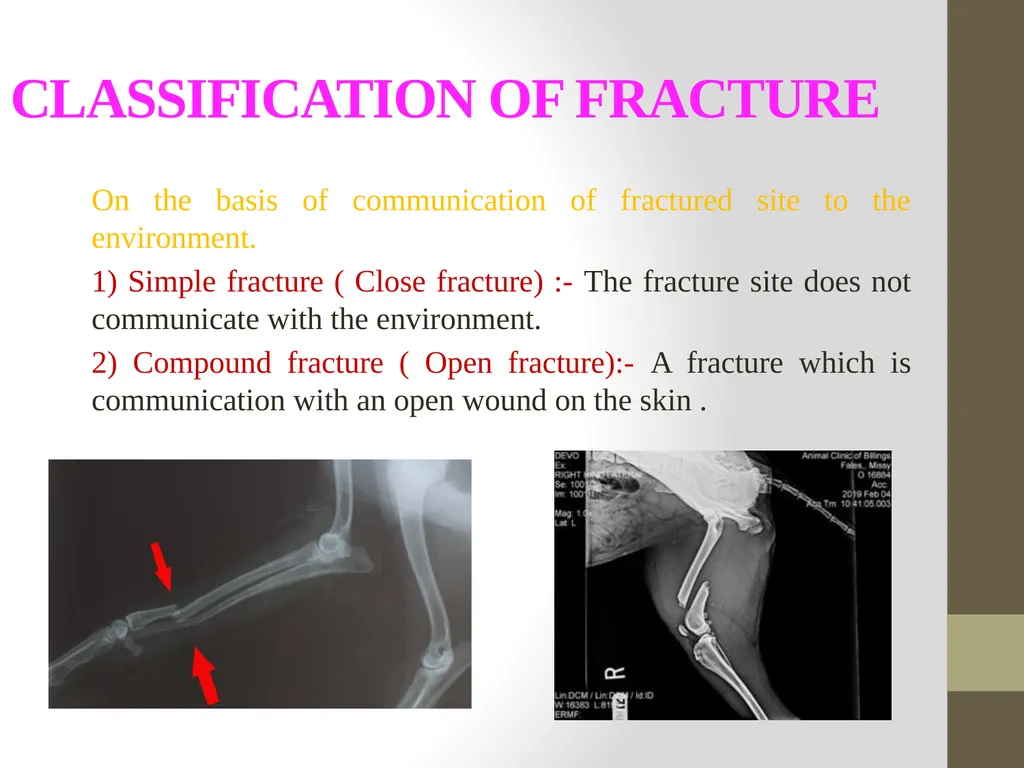 FRACTURE CLASSIFICATION Submitted by:- DR.Kumari - slide 3 of 16