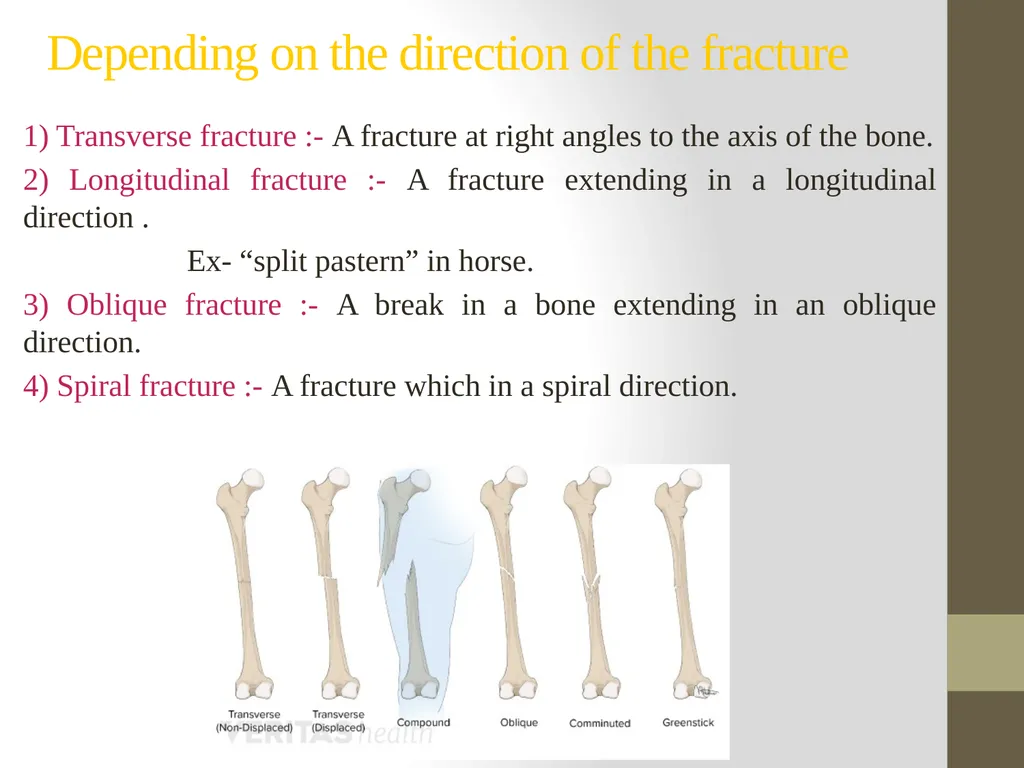 FRACTURE CLASSIFICATION Submitted by:- DR.Kumari - slide 12 of 16