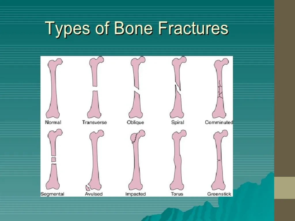 FRACTURE CLASSIFICATION Submitted by:- DR.Kumari - slide 11 of 16