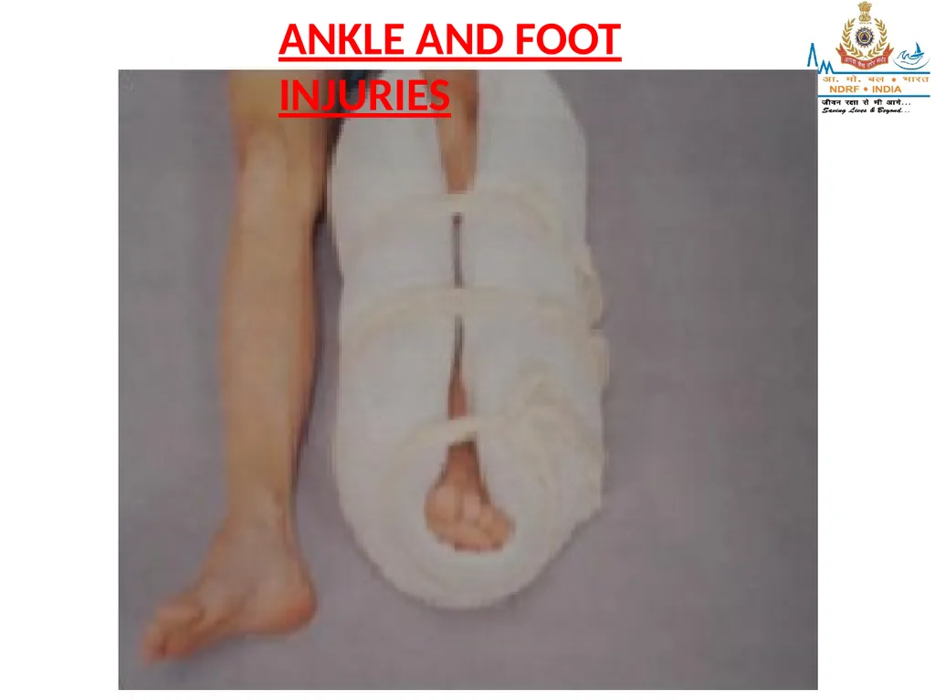 MUSCULOSKELETAL INJURIES LESSON -20 BY JITENDER - slide 46 of 58