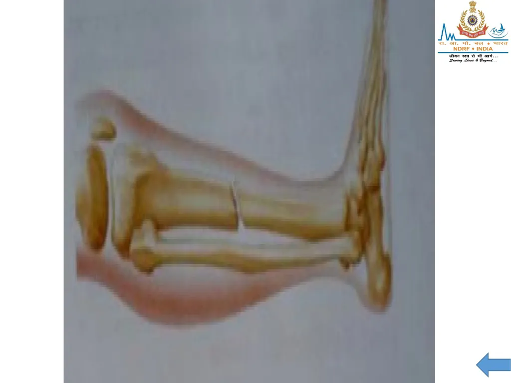 MUSCULOSKELETAL INJURIES LESSON -20 BY JITENDER - slide 49 of 58