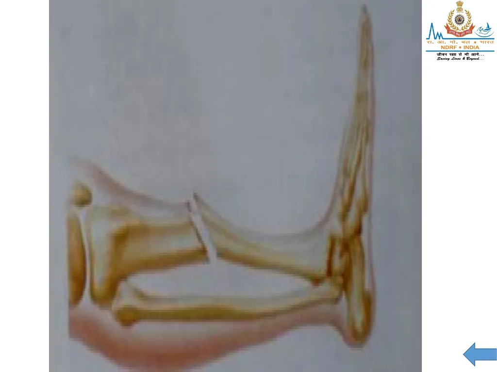 MUSCULOSKELETAL INJURIES LESSON -20 BY JITENDER - slide 50 of 58