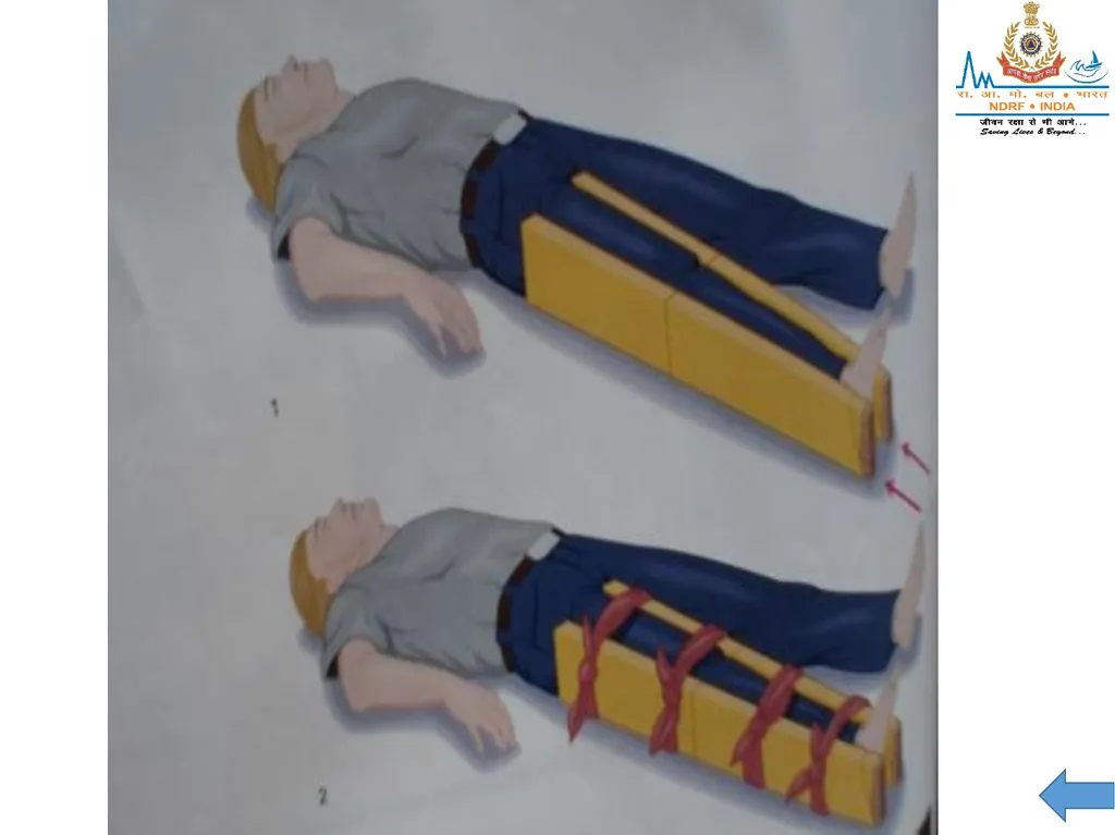 MUSCULOSKELETAL INJURIES LESSON -20 BY JITENDER - slide 51 of 58