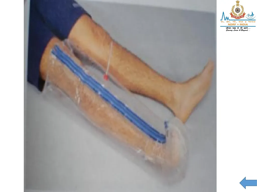MUSCULOSKELETAL INJURIES LESSON -20 BY JITENDER - slide 52 of 58