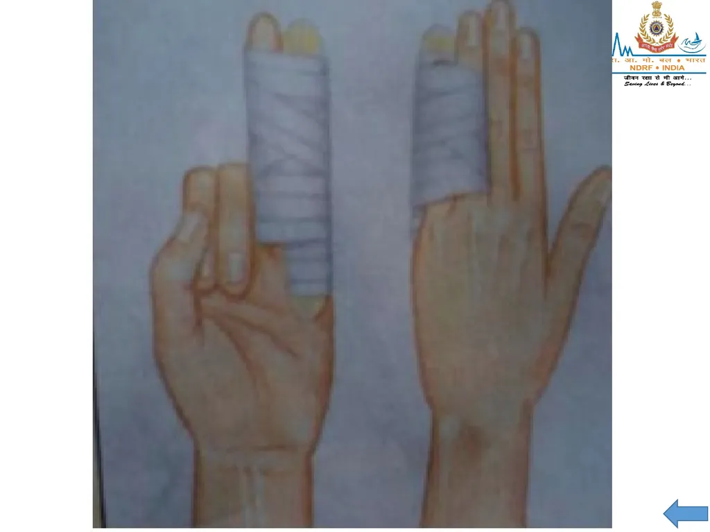 MUSCULOSKELETAL INJURIES LESSON -20 BY JITENDER - slide 58 of 58