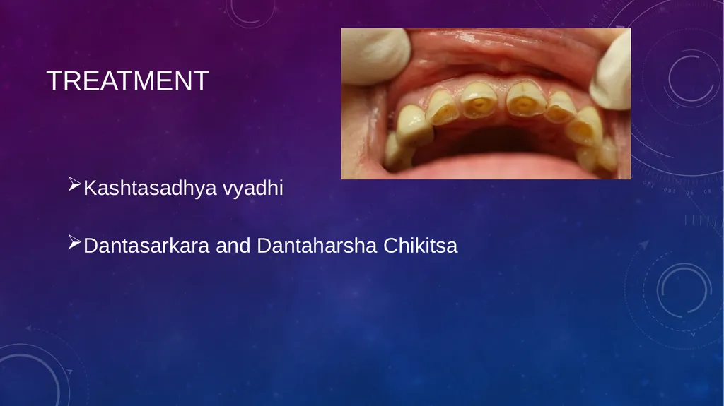 Dental Disorders in Ayurveda Danta Rogas Ayurveda - slide 17 of 28