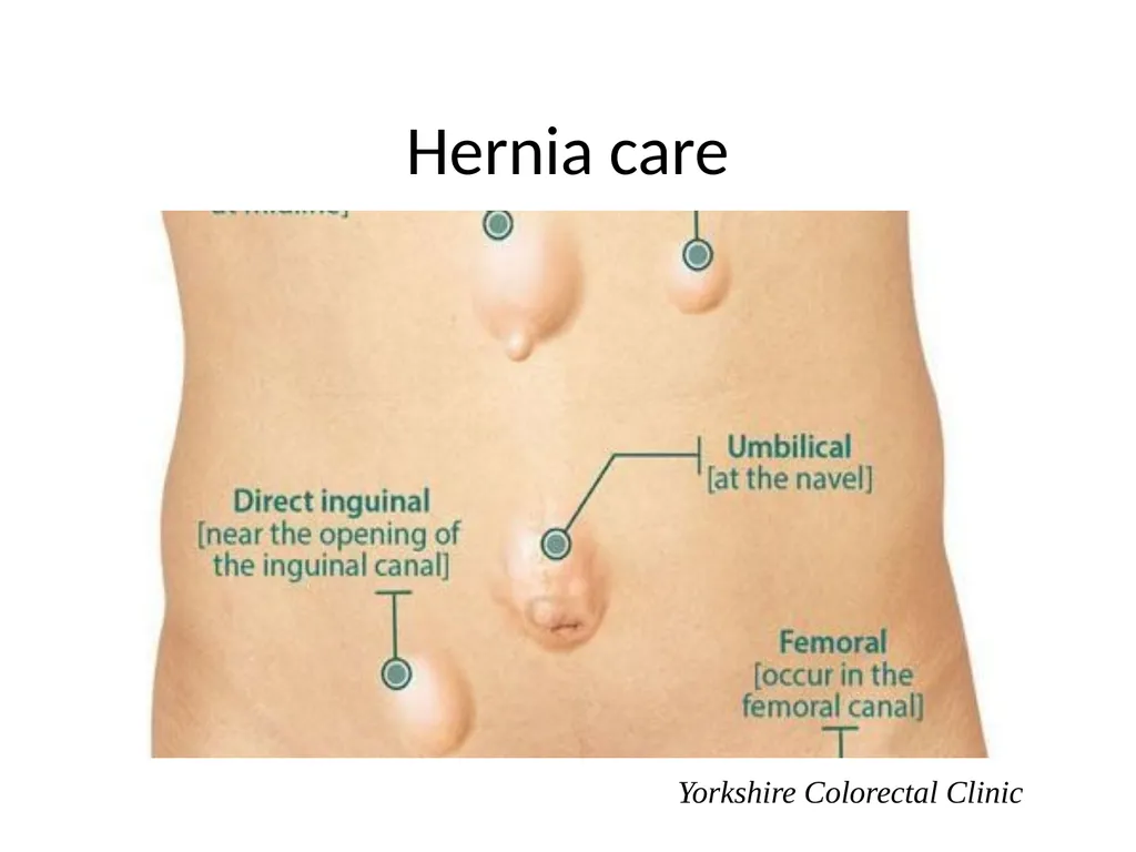 Everything there is to know about colorectal - slide 61 of 73