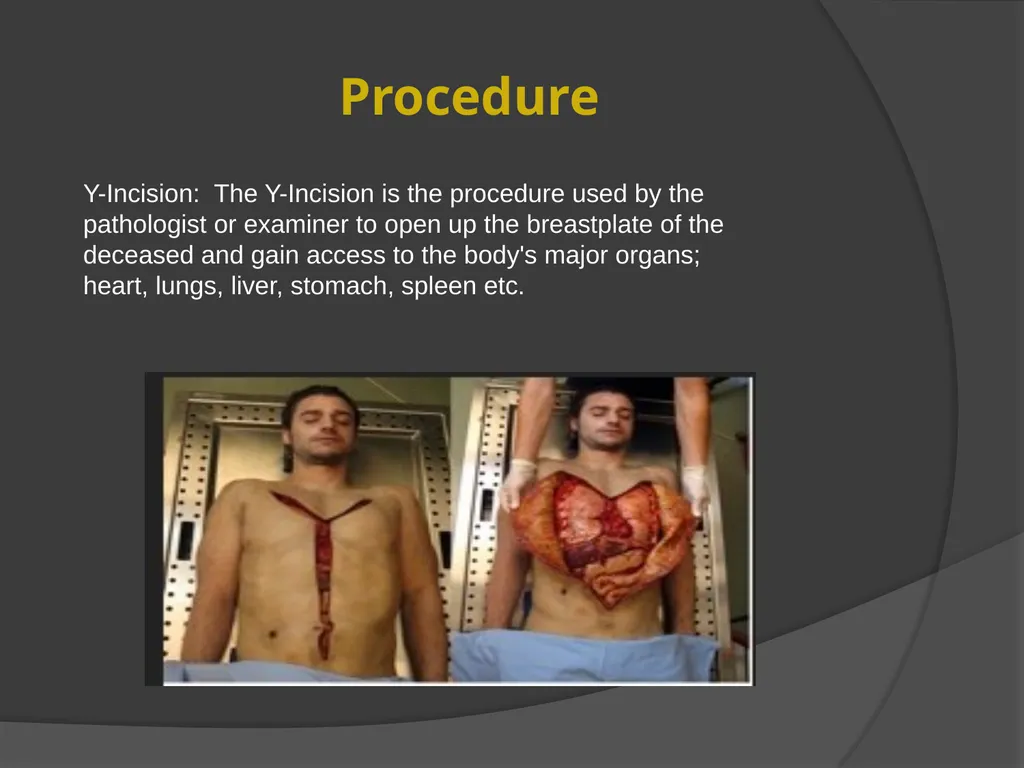 AUTOPSIES Autopsy; also called necropsy, - slide 14 of 21