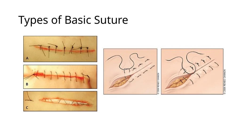 Laceration and Wound care 101 Dr. Amy Sikes - slide 13 of 18