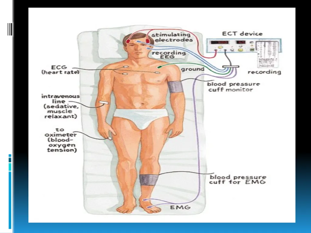 ElECTROCONVULSIVE THERAPY (E.C.T) INTRODUCTION:- - slide 15 of 32