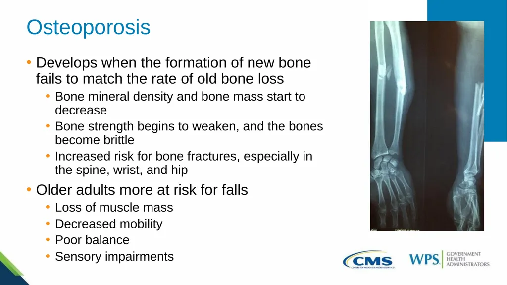 Medicare Preventive Services for Bone Mass - slide 6 of 32