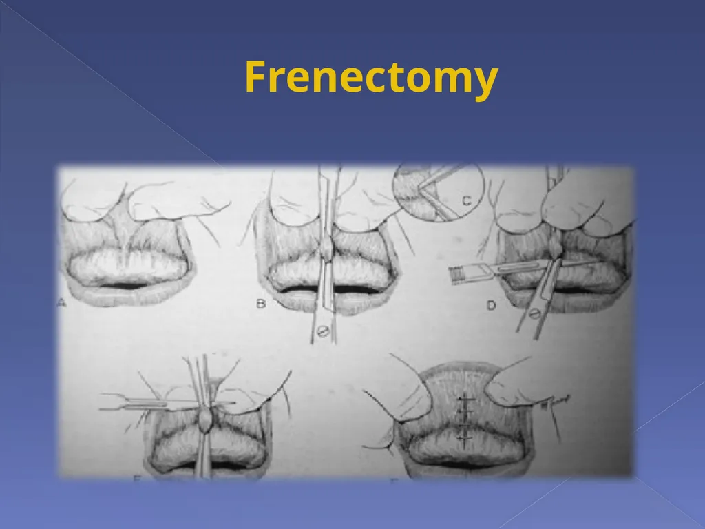 SOFT TISSUE PROCEDURES By Dr. Nazhat M. AL- - slide 4 of 7