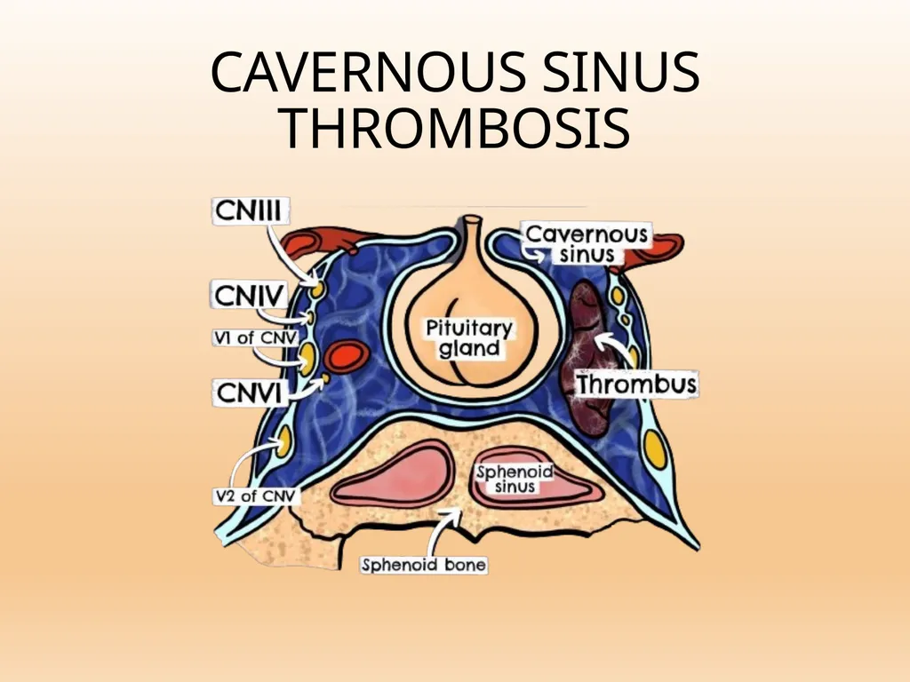 CAVERNOUS SINUS THROMBOSIS Cavernous Sinus Anatomy - slide 1 of 29