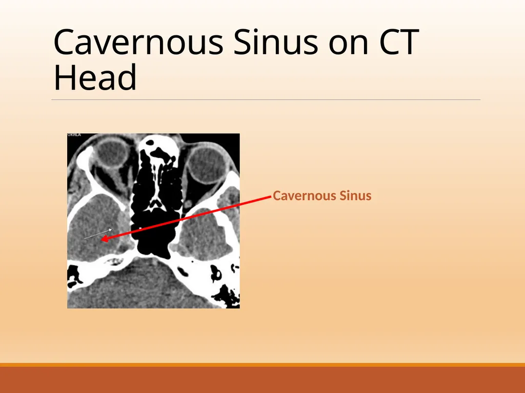 CAVERNOUS SINUS THROMBOSIS Cavernous Sinus Anatomy - slide 15 of 29