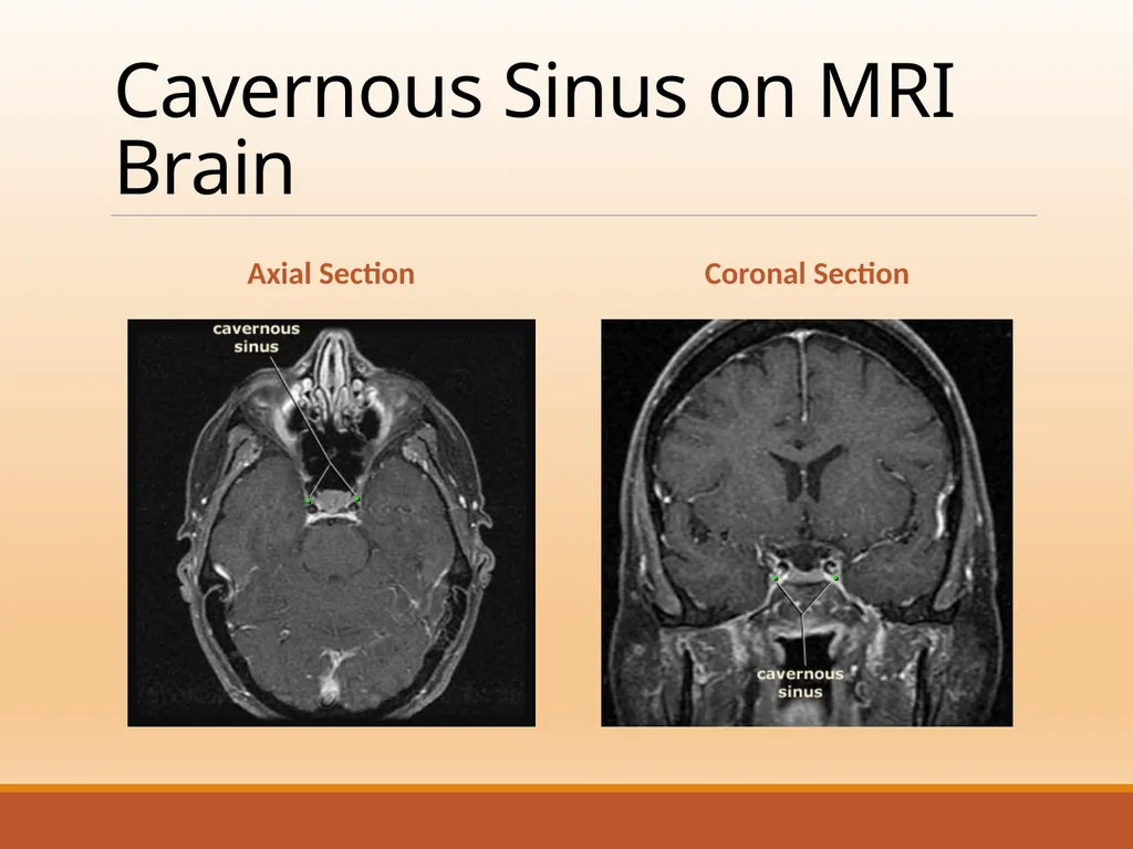 CAVERNOUS SINUS THROMBOSIS Cavernous Sinus Anatomy - slide 16 of 29