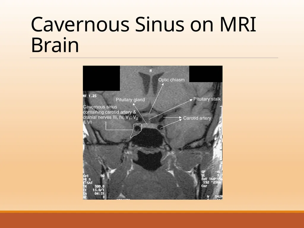 CAVERNOUS SINUS THROMBOSIS Cavernous Sinus Anatomy - slide 17 of 29