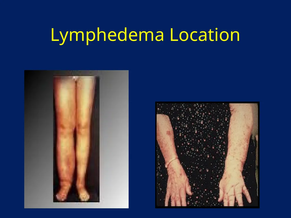 Lymphatic Disorders References Therapeutic - slide 12 of 44