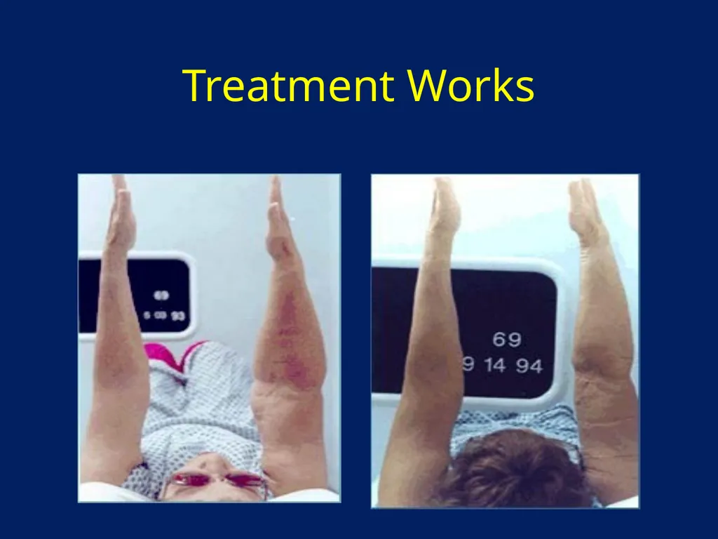 Lymphatic Disorders References Therapeutic - slide 40 of 44