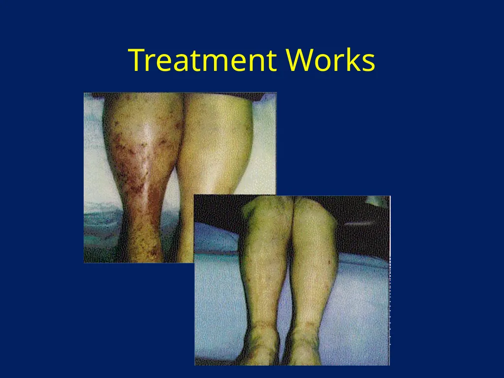 Lymphatic Disorders References Therapeutic - slide 41 of 44