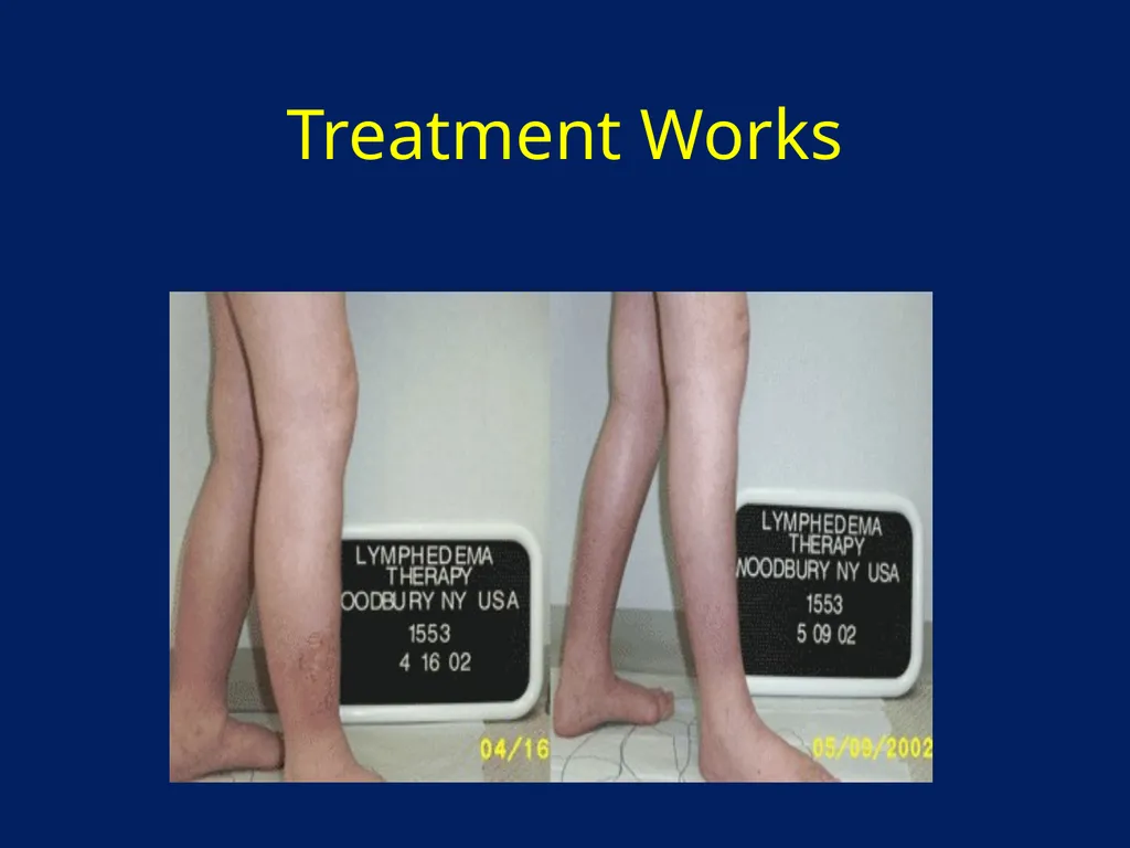 Lymphatic Disorders References Therapeutic - slide 42 of 44