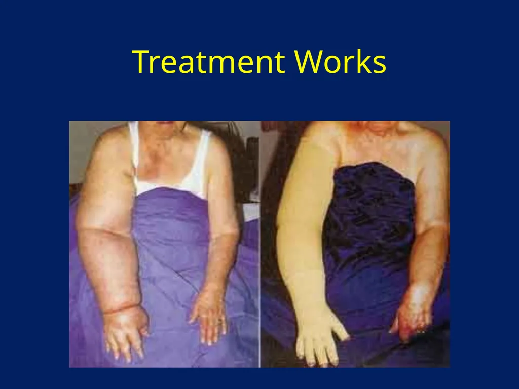 Lymphatic Disorders References Therapeutic - slide 43 of 44