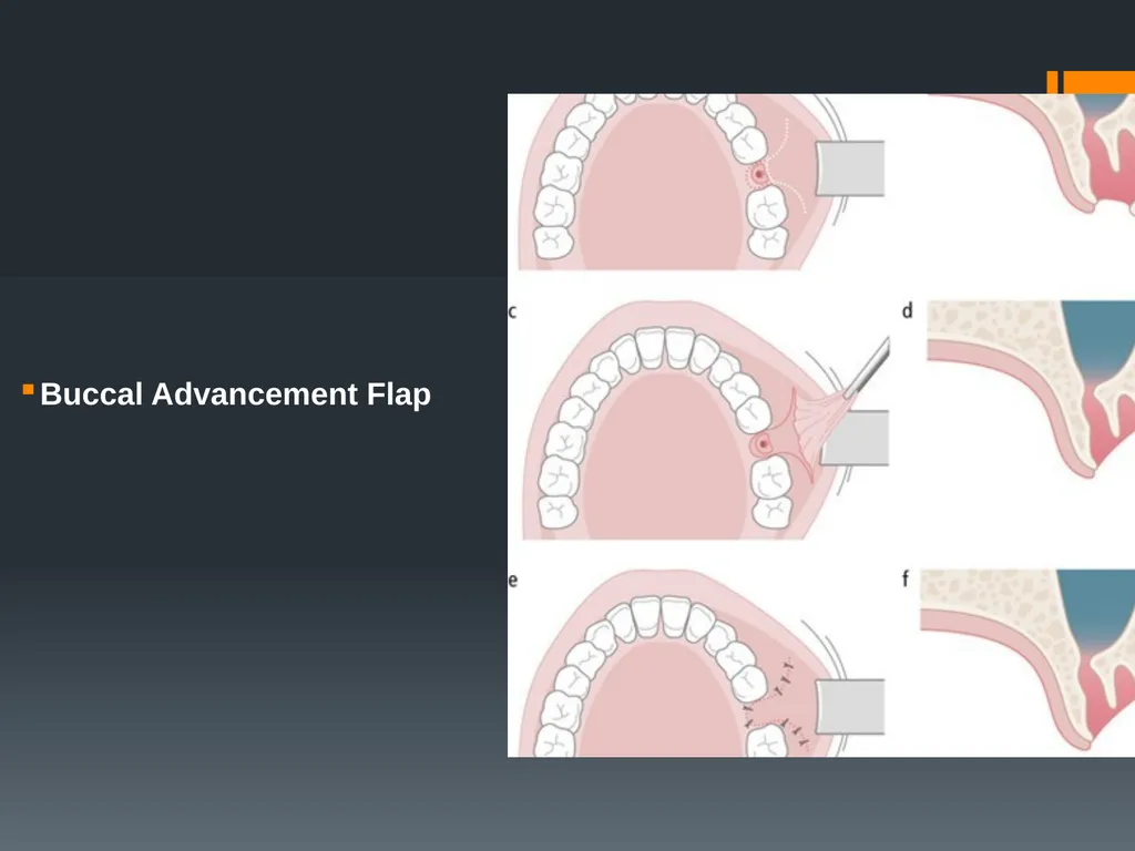 Principles of, incisions Flaps & Suturing - slide 29 of 58