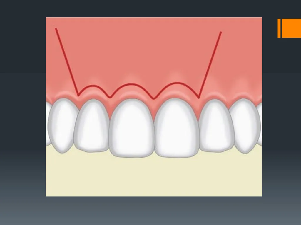 Principles of, incisions Flaps & Suturing - slide 10 of 58