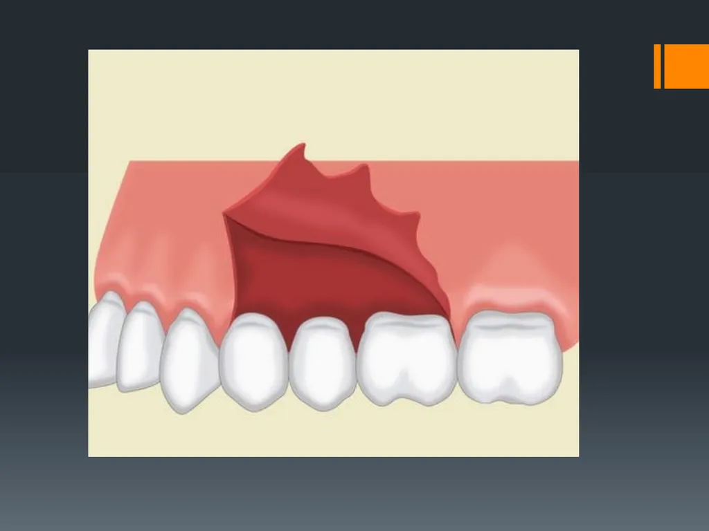 Principles of, incisions Flaps & Suturing - slide 13 of 58